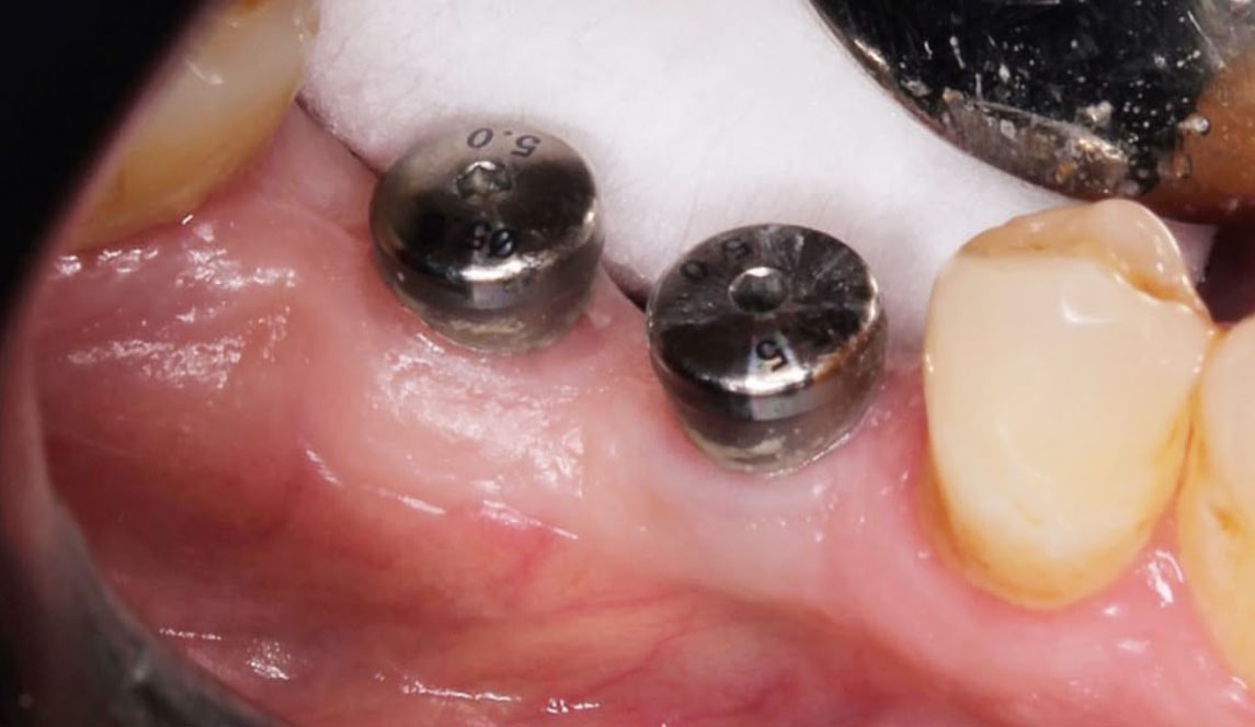 implantes